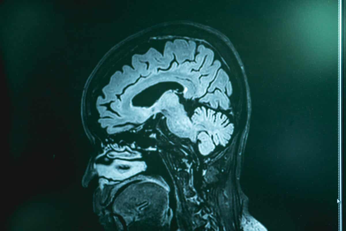 Primäre Amöben-Meningoenzephalitis - Gehirnscan