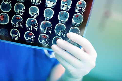 Læge ser på scanninger af hjernen