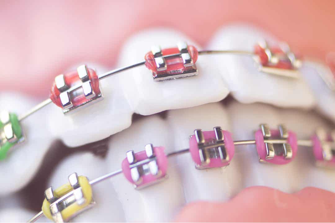 Teeth with braces with colorful bands.