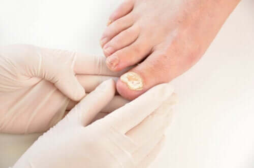 7 Ways to Prevent Fungal Nail Infections