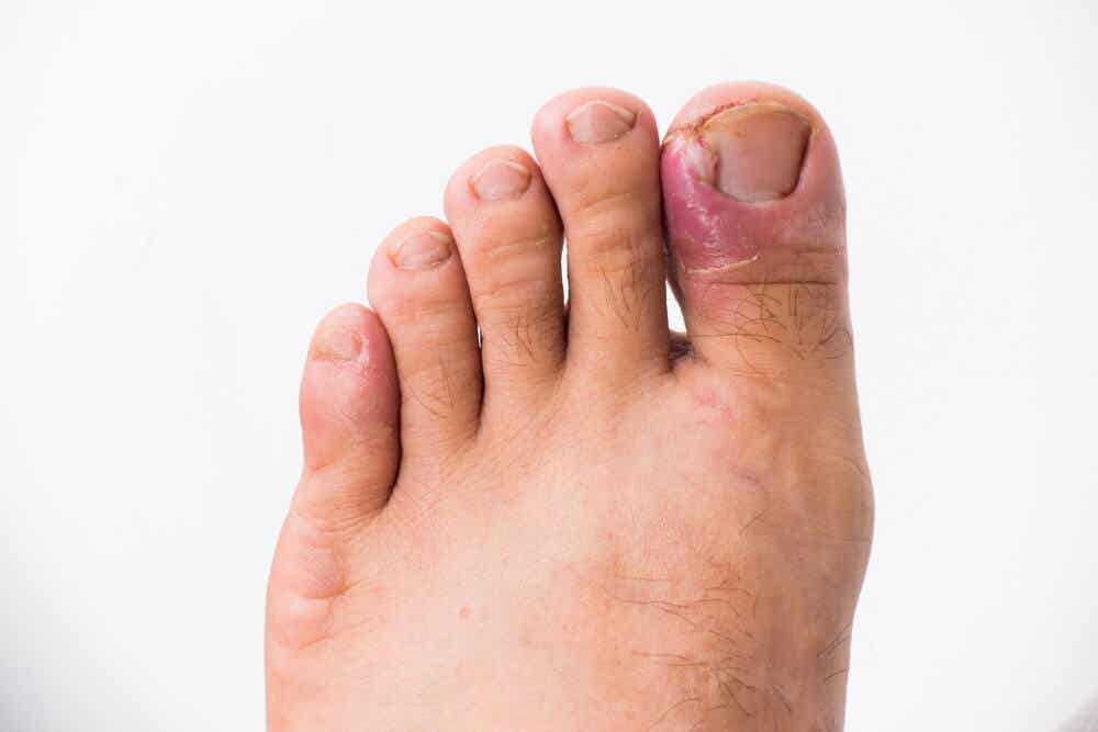 An infected toenail.