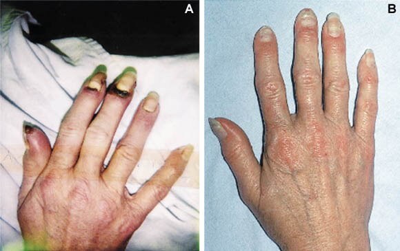 Causes, Symptoms, and Treatment of Buerger's Disease