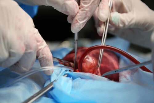 Doctors removing organs after body donation.