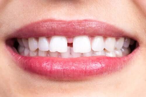 Characteristics and Causes of Dental Diastema