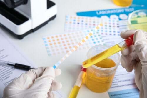 Characteristics of Membranous Nephropathy