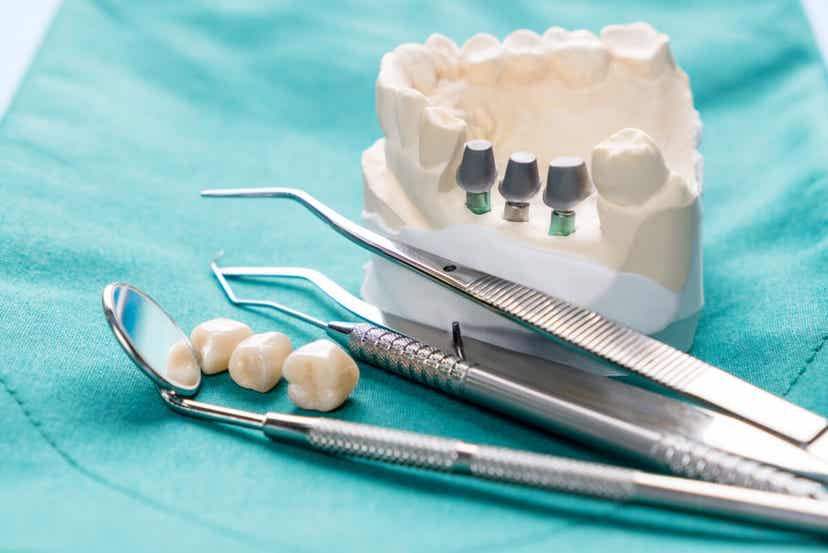 orthognatische Chirurgie - Zahnmodell