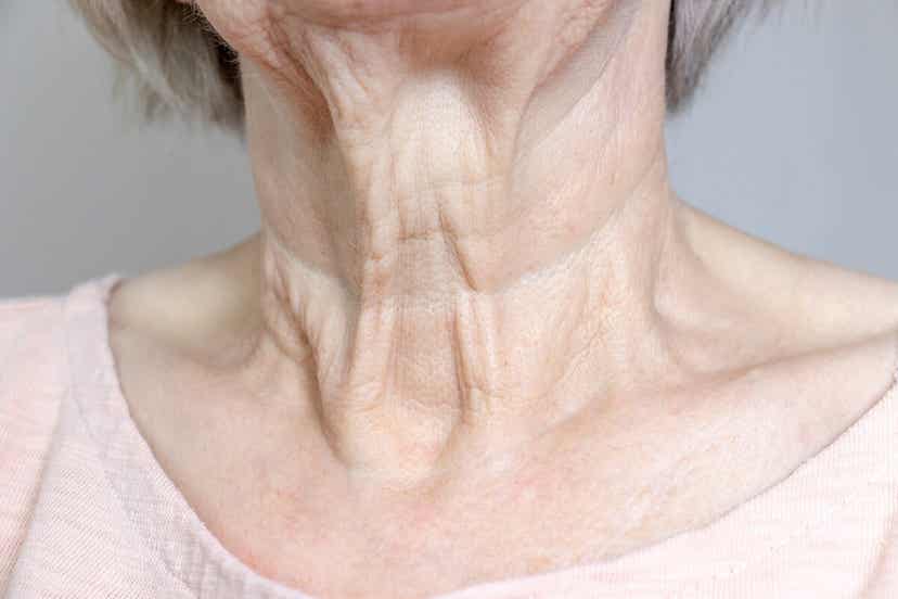 An elderly woman with sagging neck on her chin and neck.
