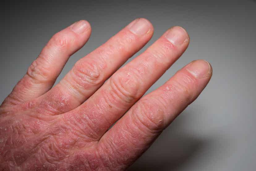 Welt-Lupus-Tag - Eine Person mit extrem trockener und roter Haut an der Hand.