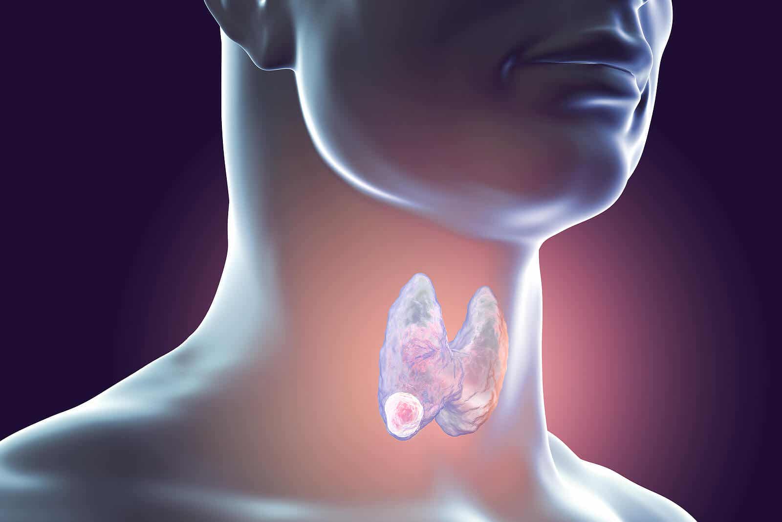 A digital illustration of a thyroid nodule.