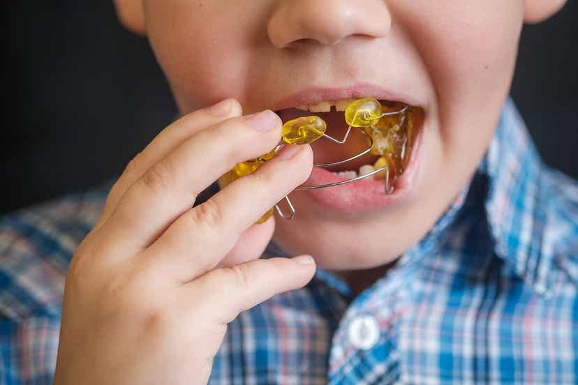 Ένα παιδί που βάζει μια ορθοδοντική συσκευή στο στόμα του.