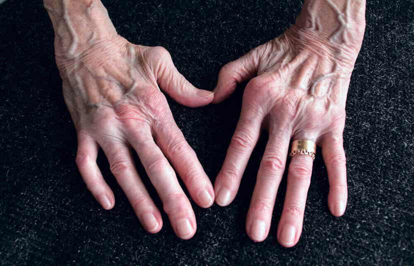 Die Hände einer älteren Frau mit Arthritis.