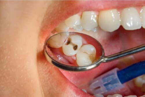 Mond met gebitsproblemen