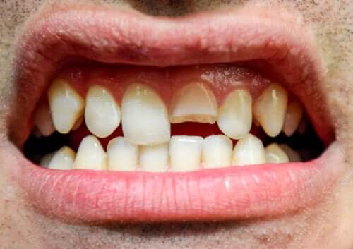 Dental Trauma: What Is It and What Types Are There?