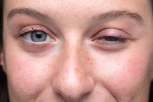 What's an Edrophonium Test and What is it for?