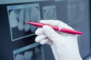 What's Enamel Hypoplasia and How Is It Treated?