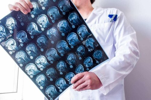 En lege som holder et bilde av en hjerne.