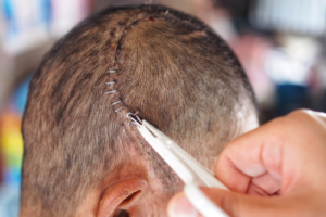 What's a Craniotomy and When's It Necessary?