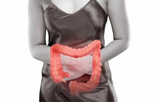 A person with Symptomatic Diverticular Stenosis.