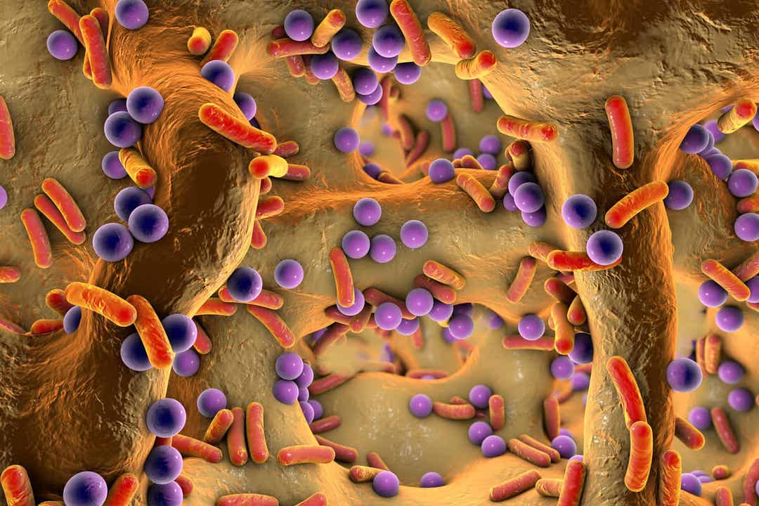 En digital illustrasjon av osteomyelitt.