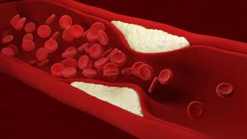 Συσσωρεύεται χοληστερόλη στην κυκλοφορία του αίματος.