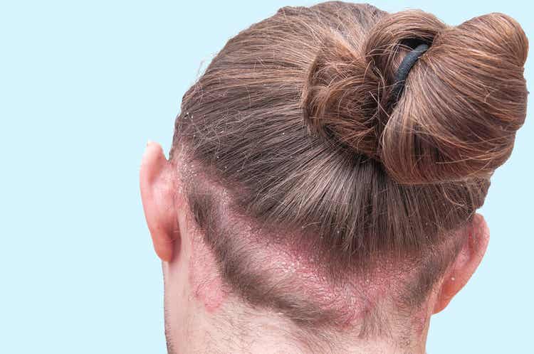 En mann med seboreisk dermatitt i nakken.