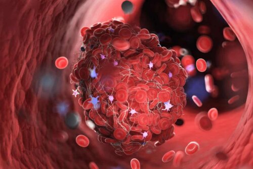 Kunstnerisk fremstilling af en blodprop i et blodkar