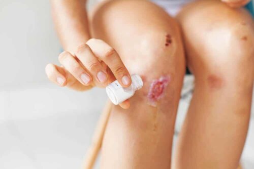 close up knee scrape administrating some topical treatment