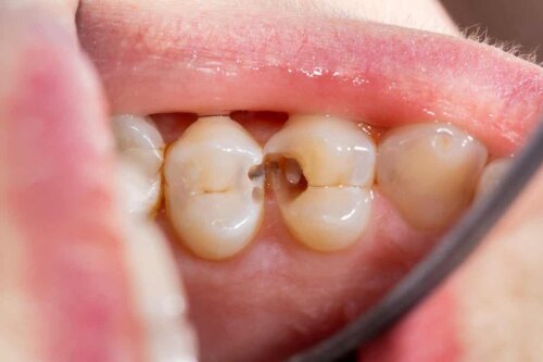 κοντινό πλάνο κοιλοτήτων στα δόντια του ασθενούς