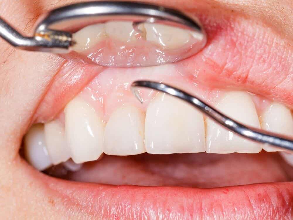 A dentist scrapes plaque off a tooth.