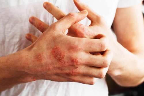Person med psoriasis på hænder klør sig selv