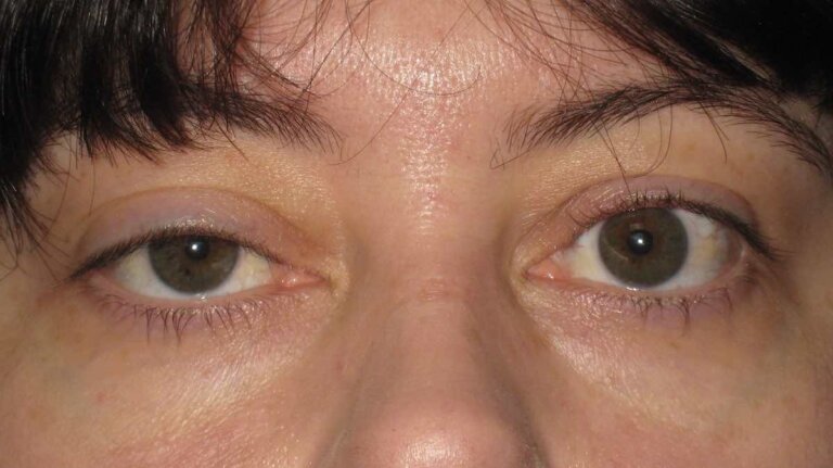 Ptosis or Droopy Eyelid: Causes and Treatments