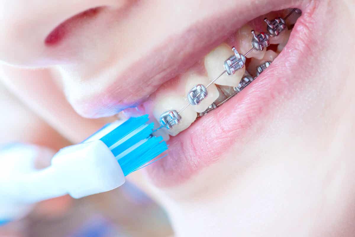 En jente med tannregulering som pusser tennene.