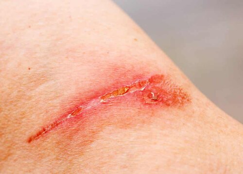 A wound on a person's skin.