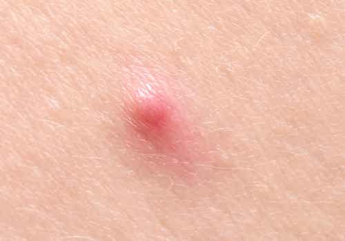 A cyst on skin