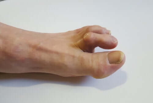 Symptoms, Causes and Treatment of Hammertoes