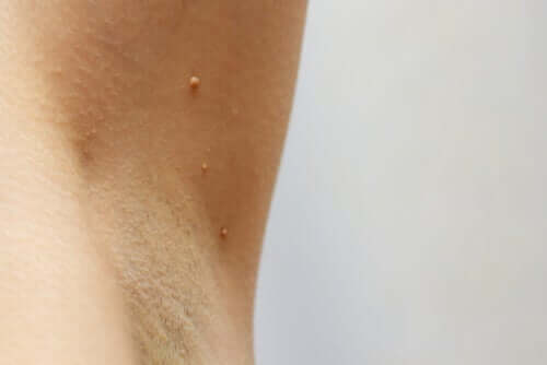 The Common Treatments of Underarm Warts