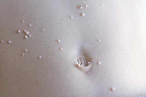 En mage med molluscum contagiosum.