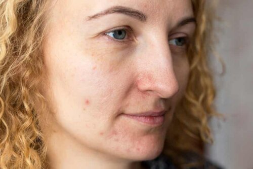 Kvinde med uren hud