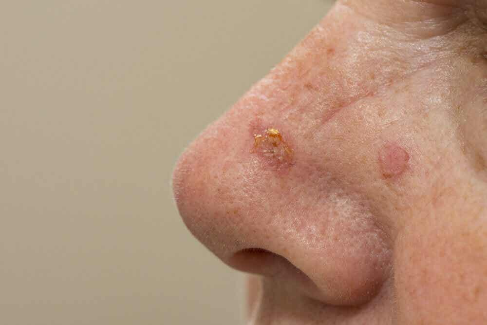 Aktinisk keratose på næse
