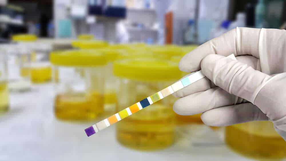 Different colors on a urine test.