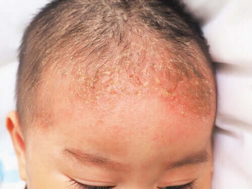 What's Seborrheic Dermatitis in Infants?