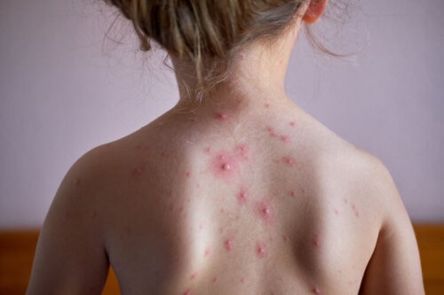 Is Chickenpox More Common in the Spring?