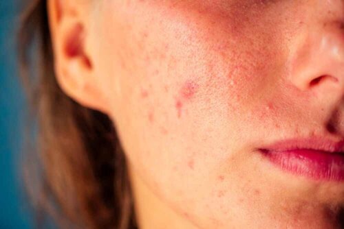 close up of a woman's face acne marks spots and marks