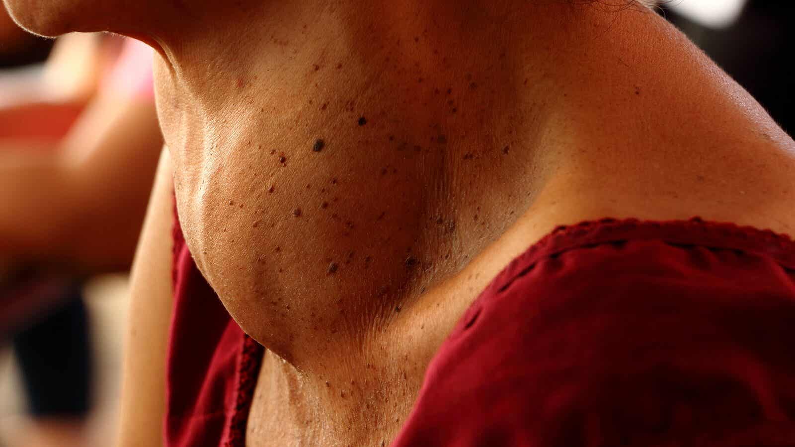 Szyja z wolem, obrzęk tarczycy.