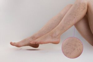 Treatments for Vascular Lesions
