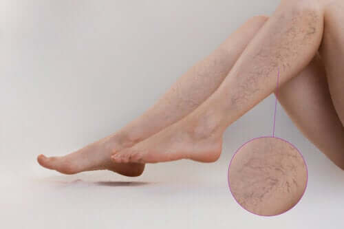 Treatments for Vascular Lesions