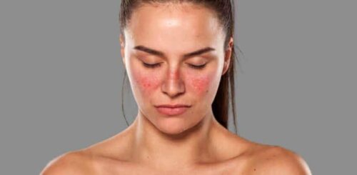 En kvinde, der lider af lupus, har udslæt i ansigtet
