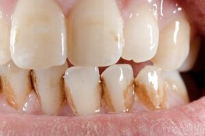 How to Remove Tartar From Your Teeth Naturally