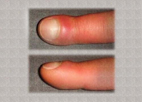 Do You Have Swollen Fingers? Learn Why Here