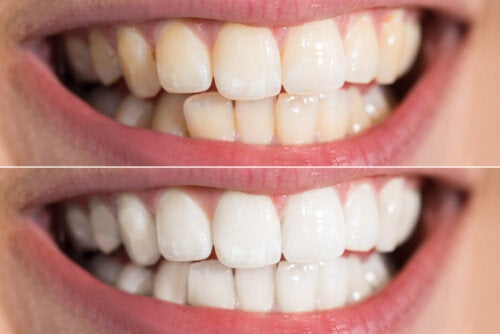 Is it Safe to Whiten Teeth at Home? Possible Risks and Recommendations
